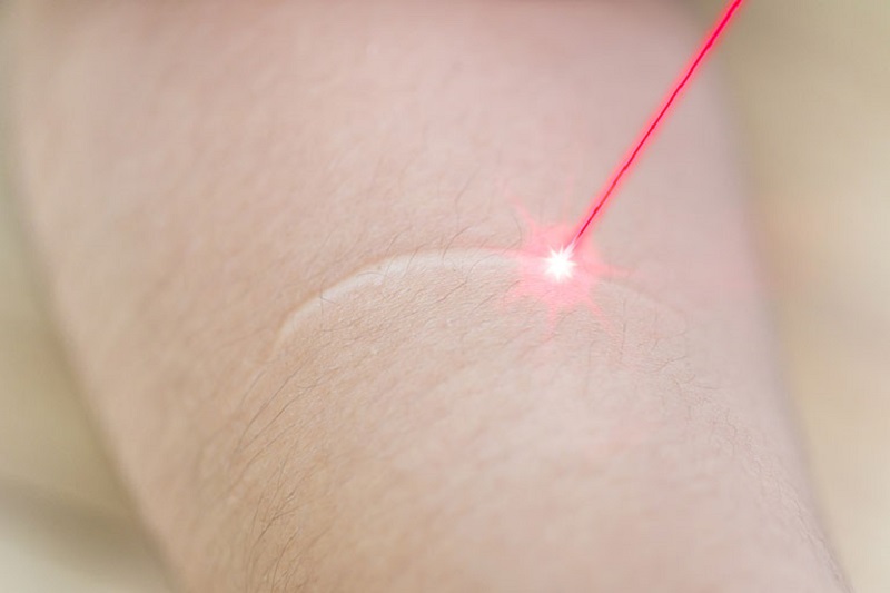 laser trị sẹo sau bỏng