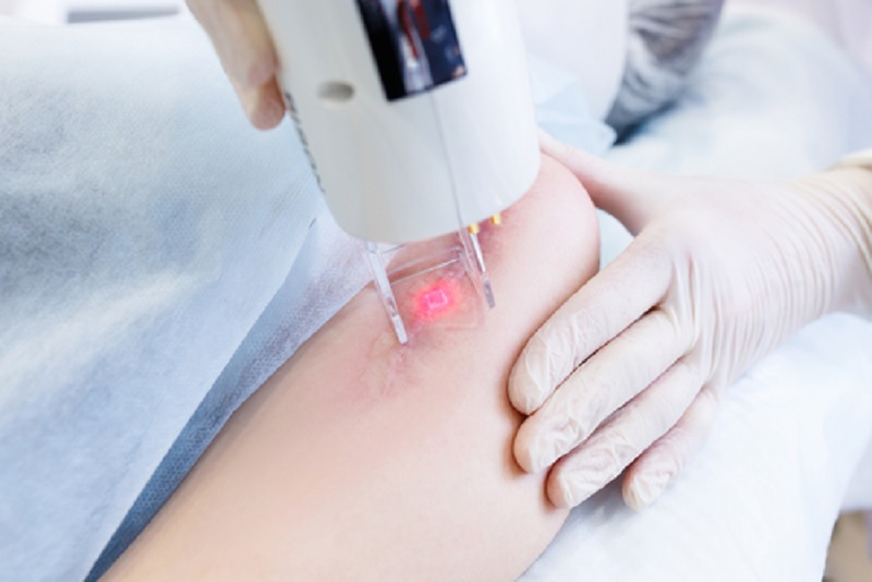 công nghệ máy trị sẹo laser