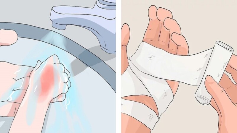 cách trị sẹo bỏng nước sôi 