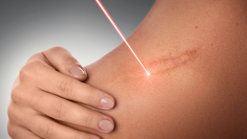 trị sẹo bỏng nước sôi bằng laser