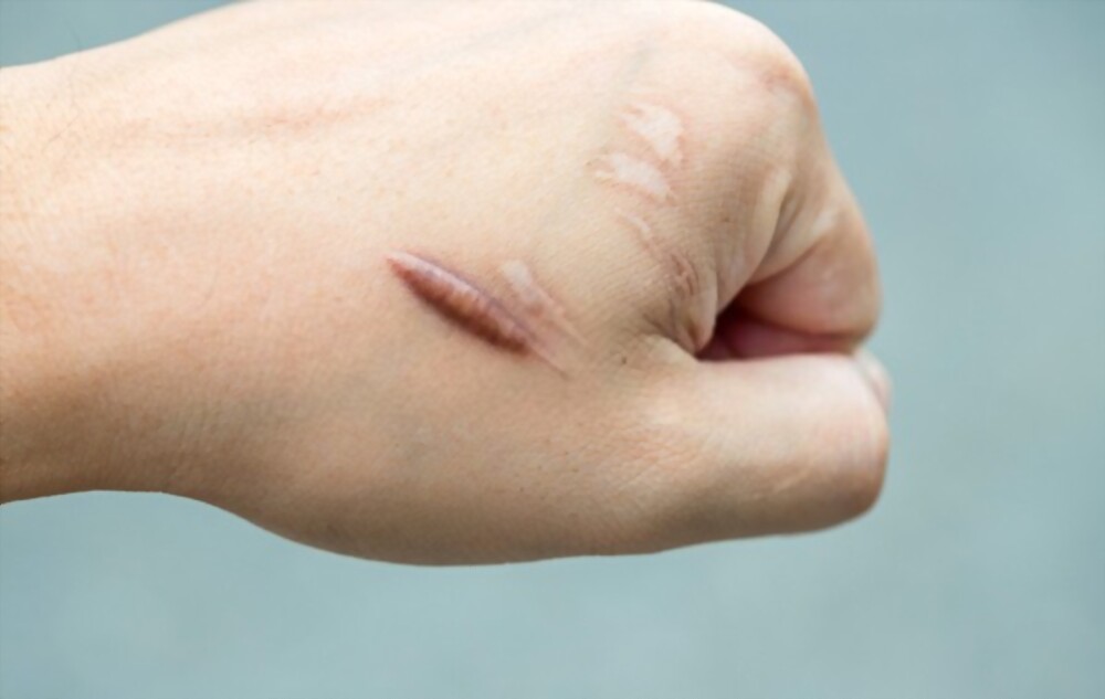 điều trị sẹo lồi