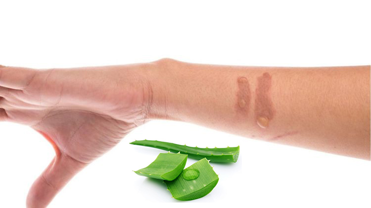 nha đam trị sẹo bỏng